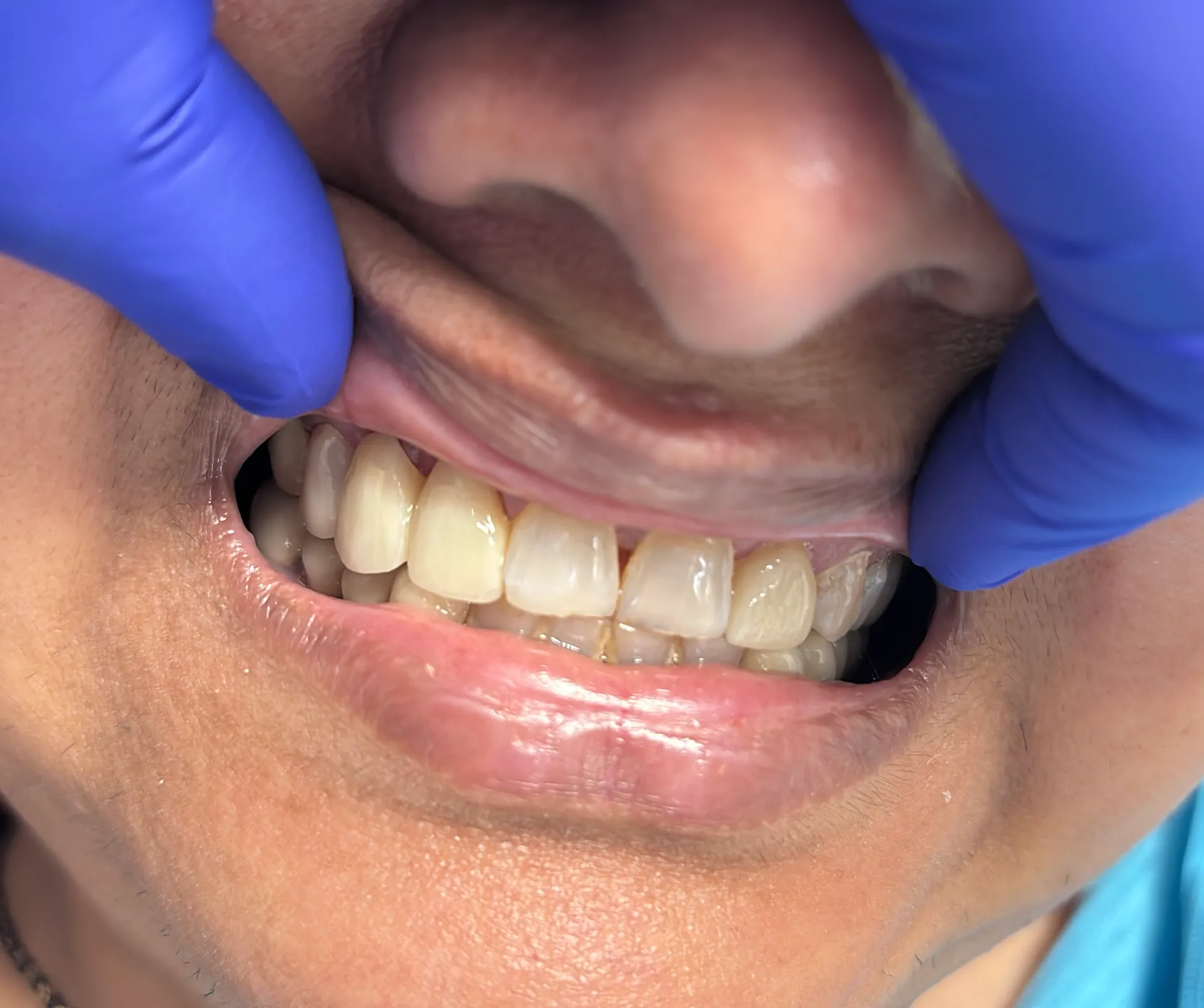 After Treatment