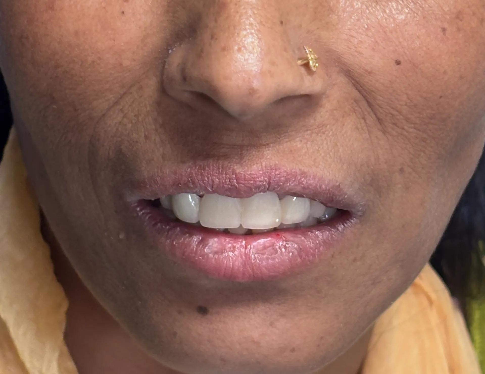 After Treatment