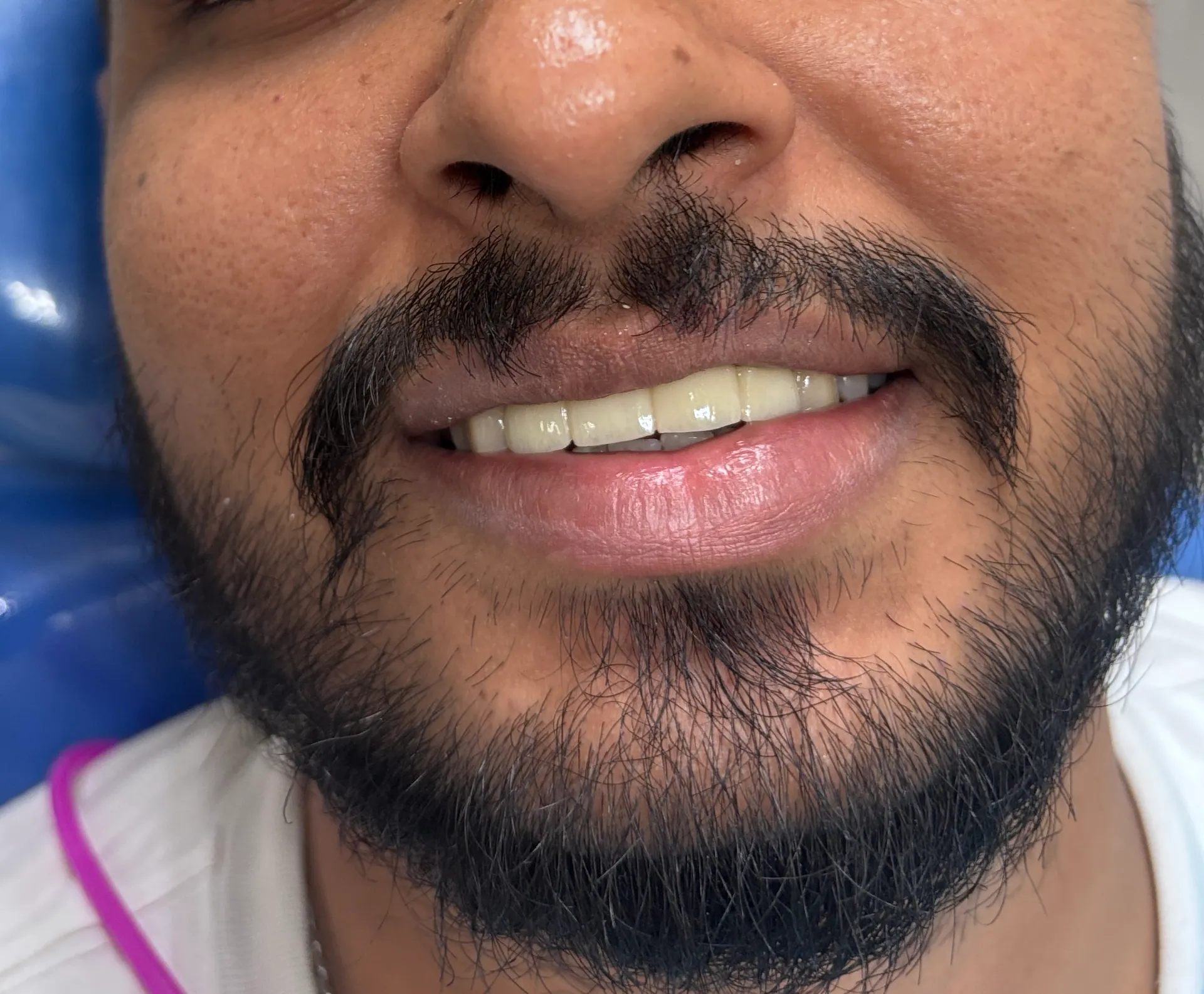 After Treatment