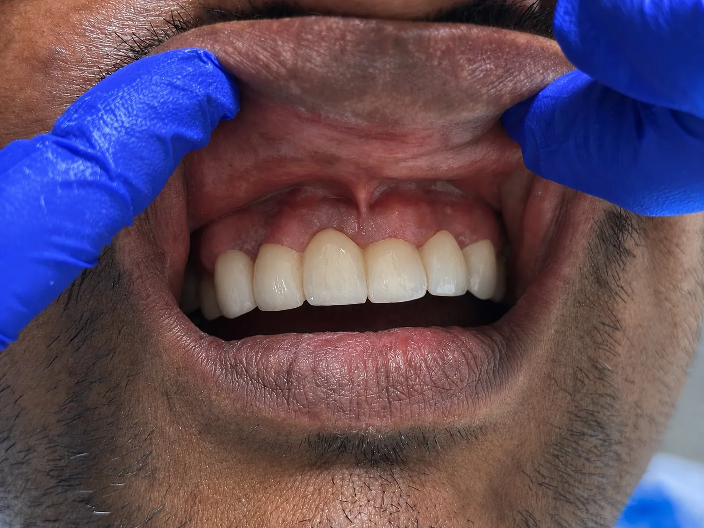 After Treatment