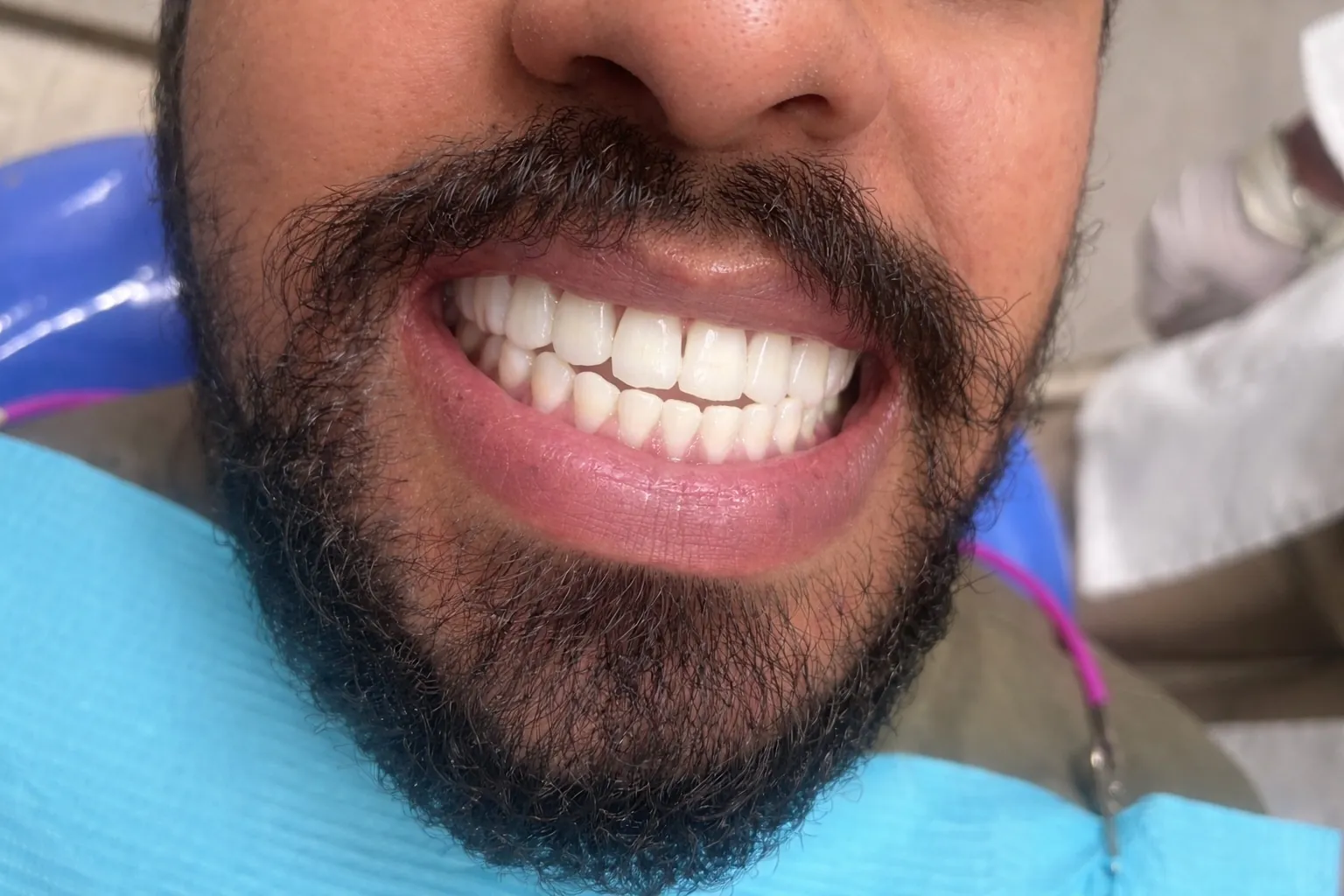 After Treatment