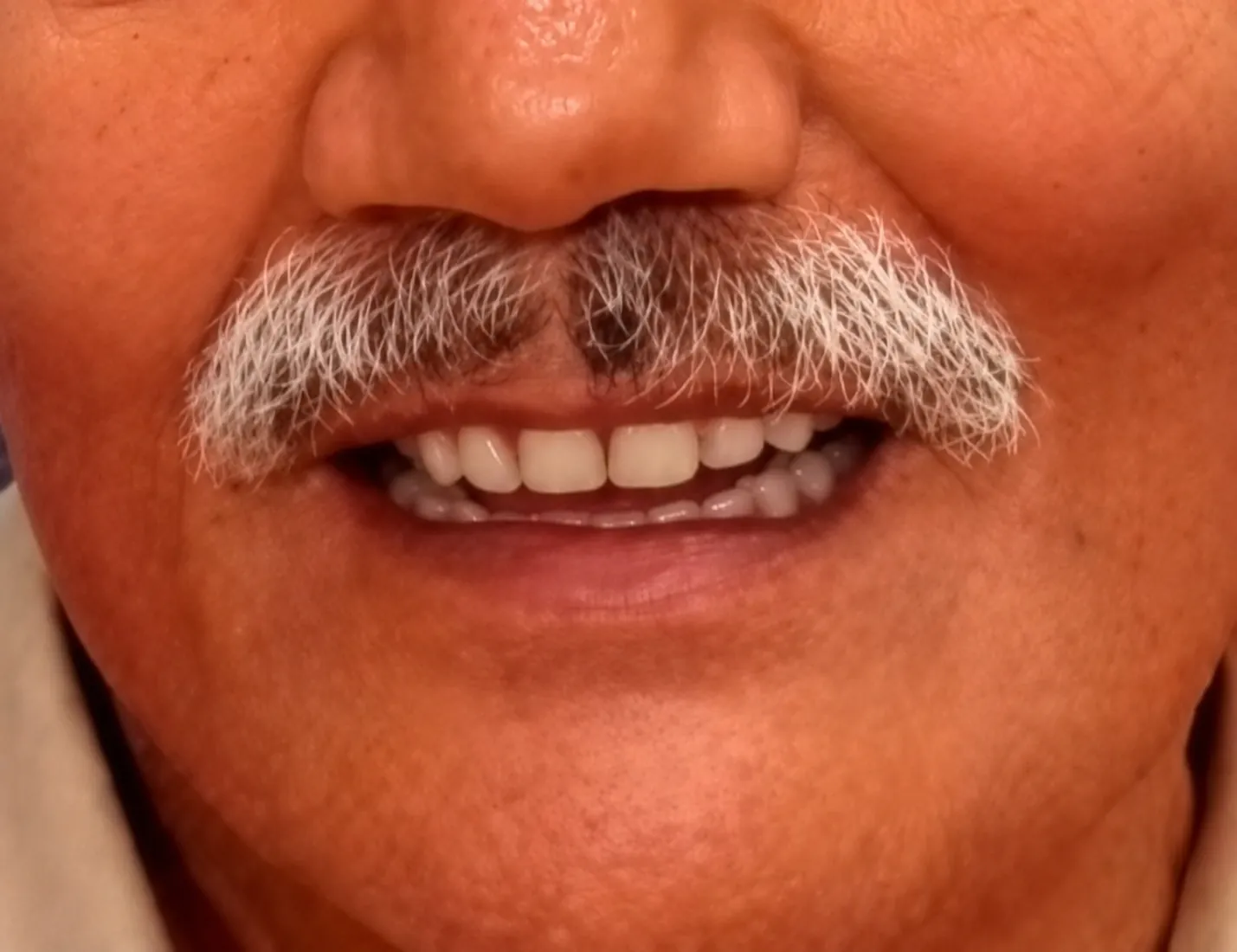 After Treatment