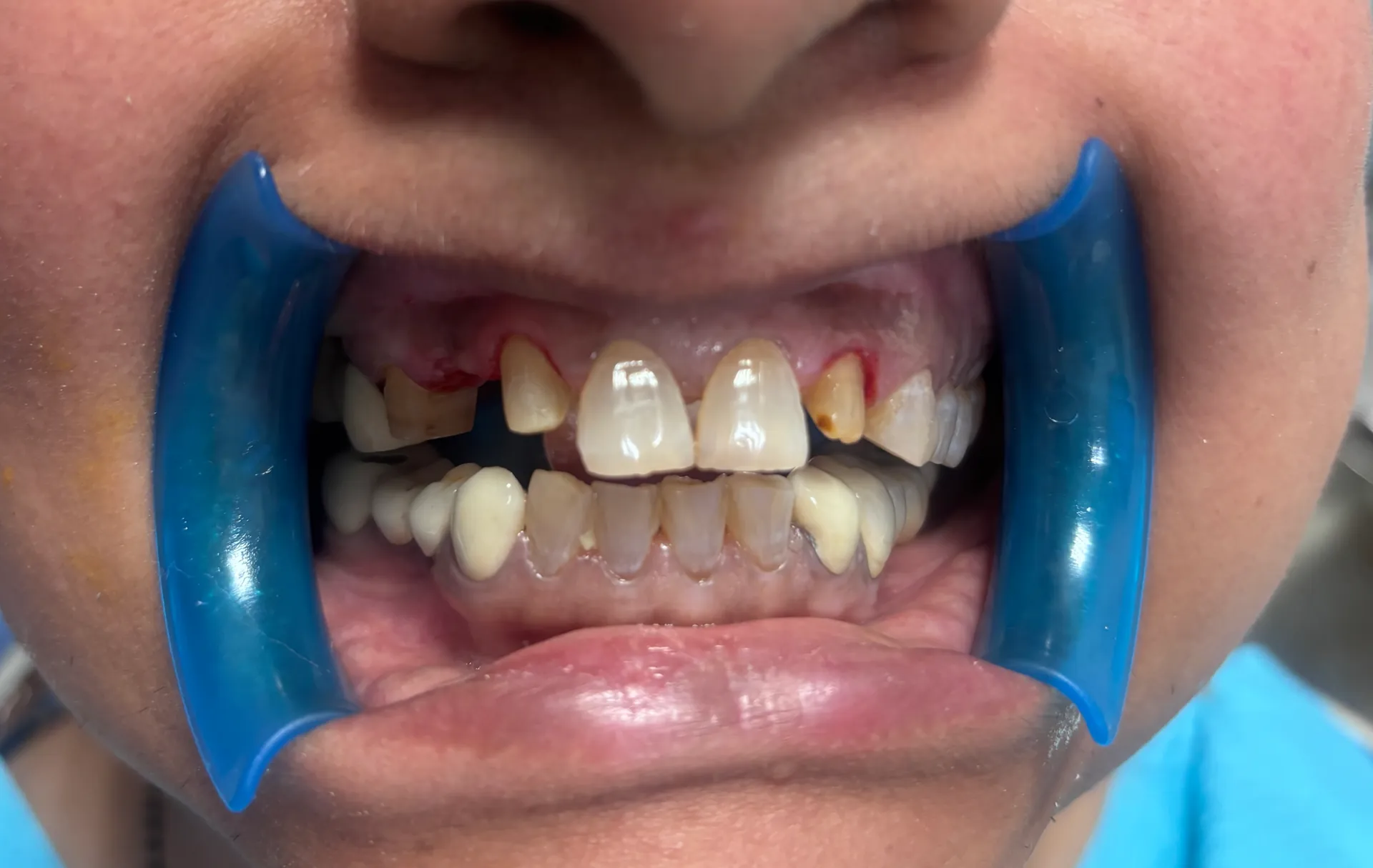 Before Treatment