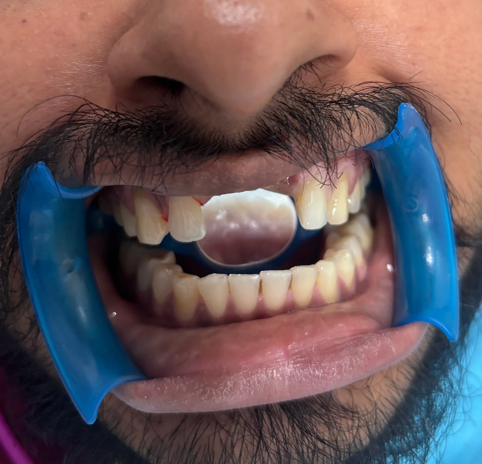 Before Treatment