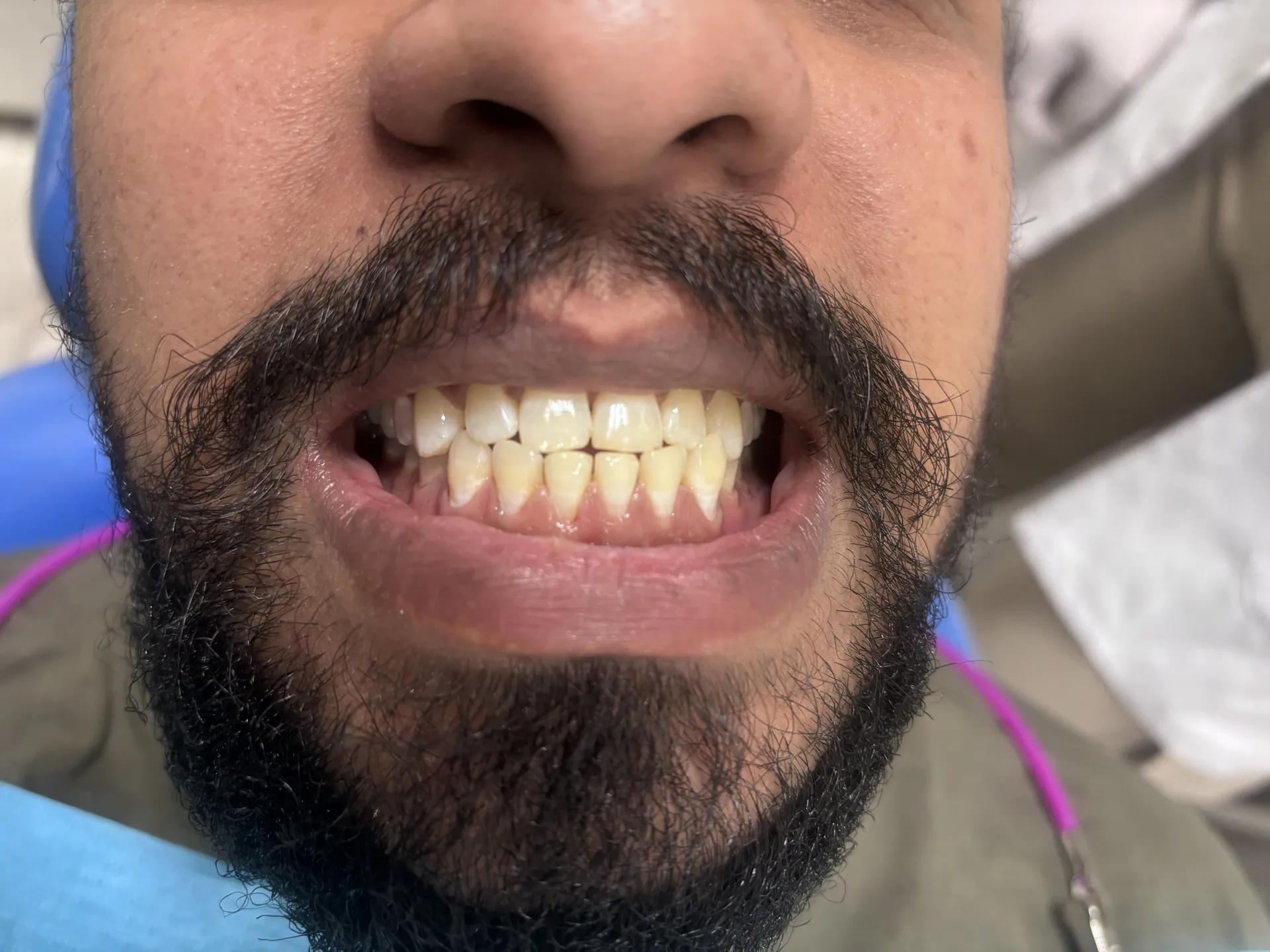 Before Treatment