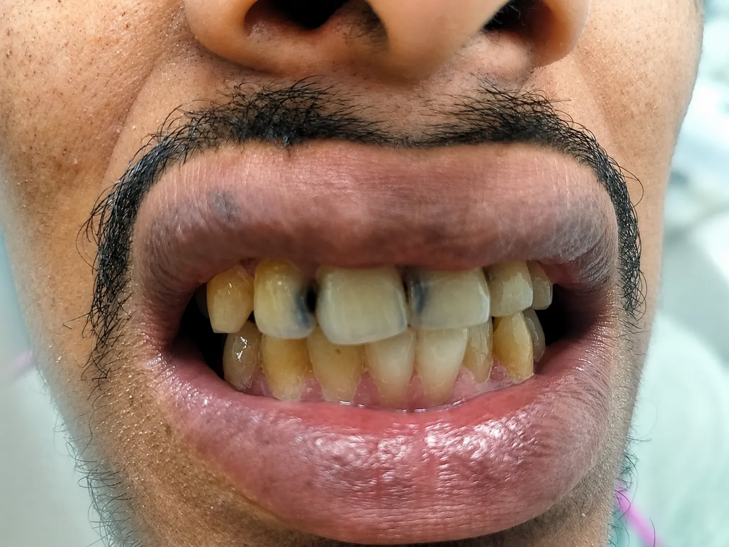 Before Treatment