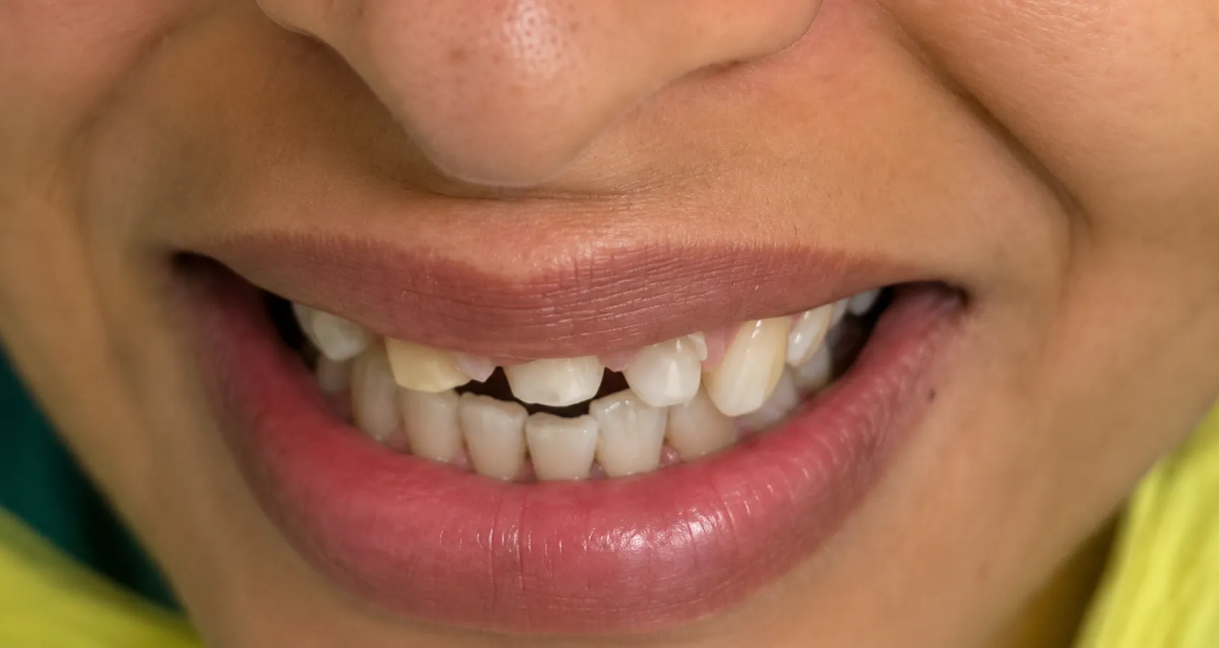 Before Treatment